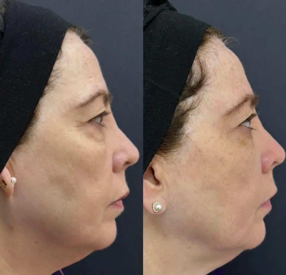 Resultado PicoGlow 1