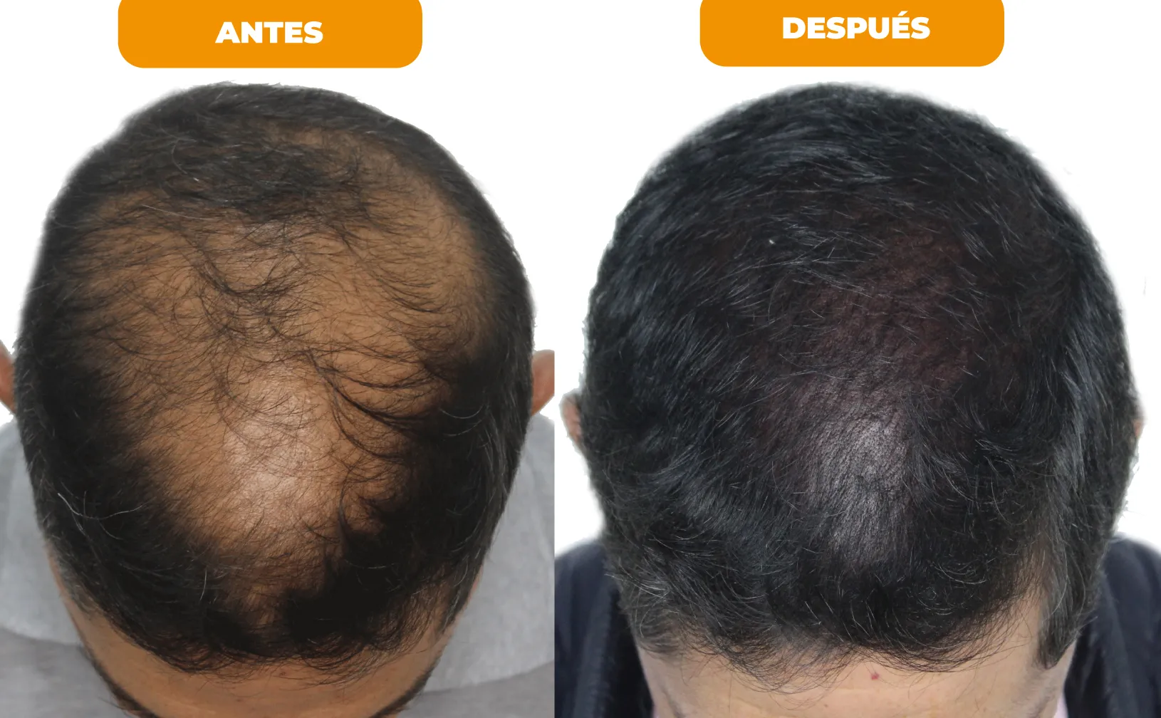 Resultado tratamiento capilar 1