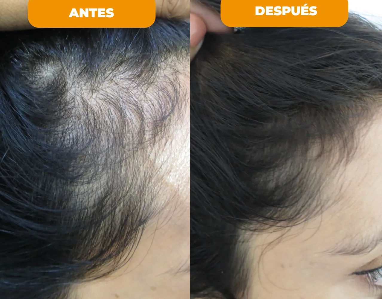 Resultado tratamiento capilar 2