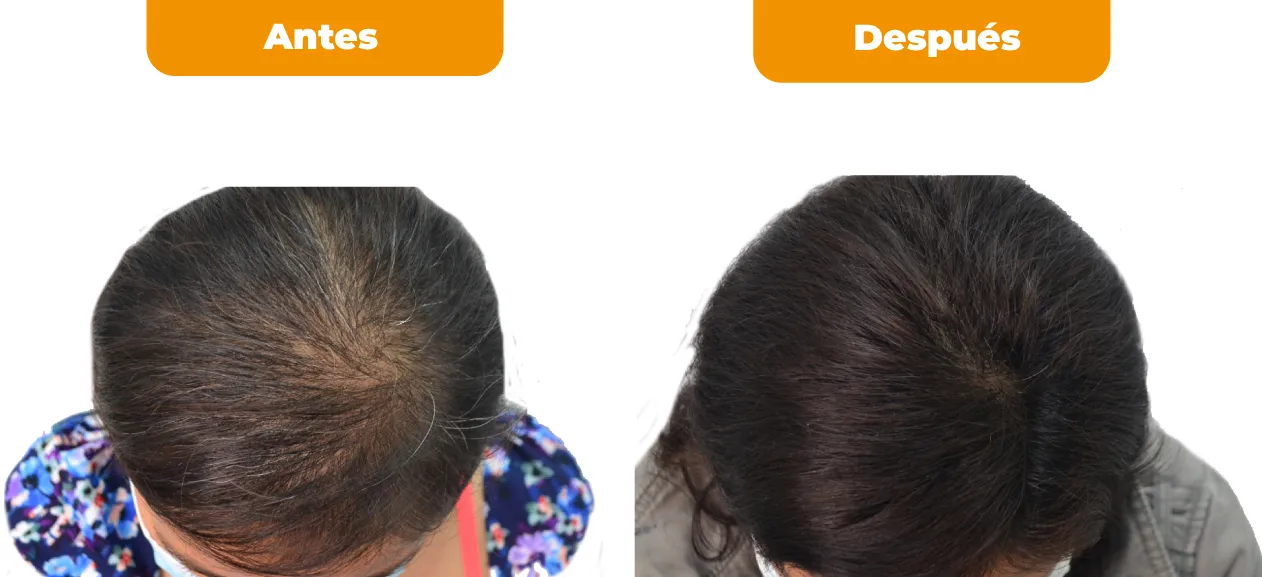 Resultado tratamiento capilar 4