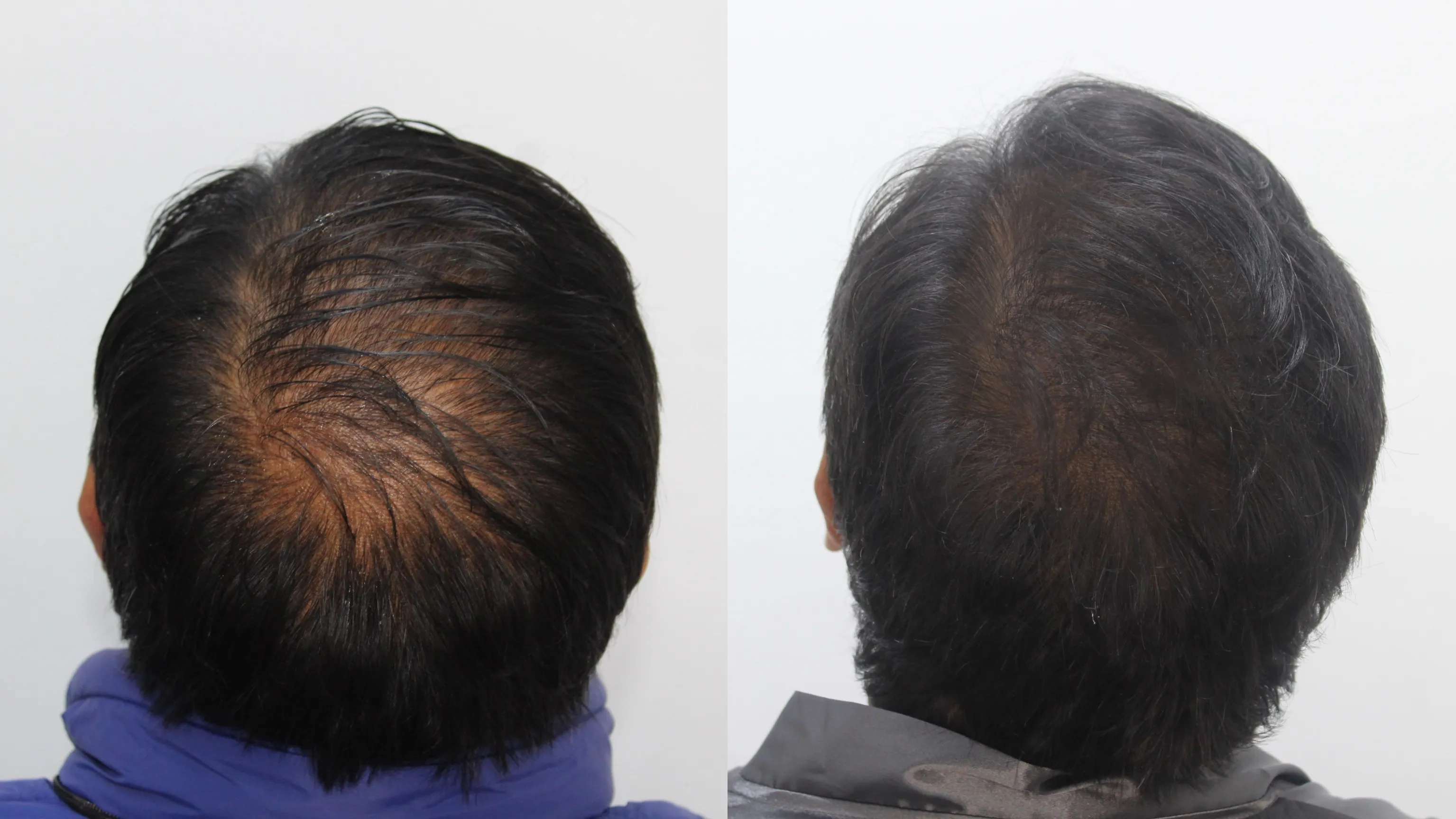 Resultado tratamiento capilar 3