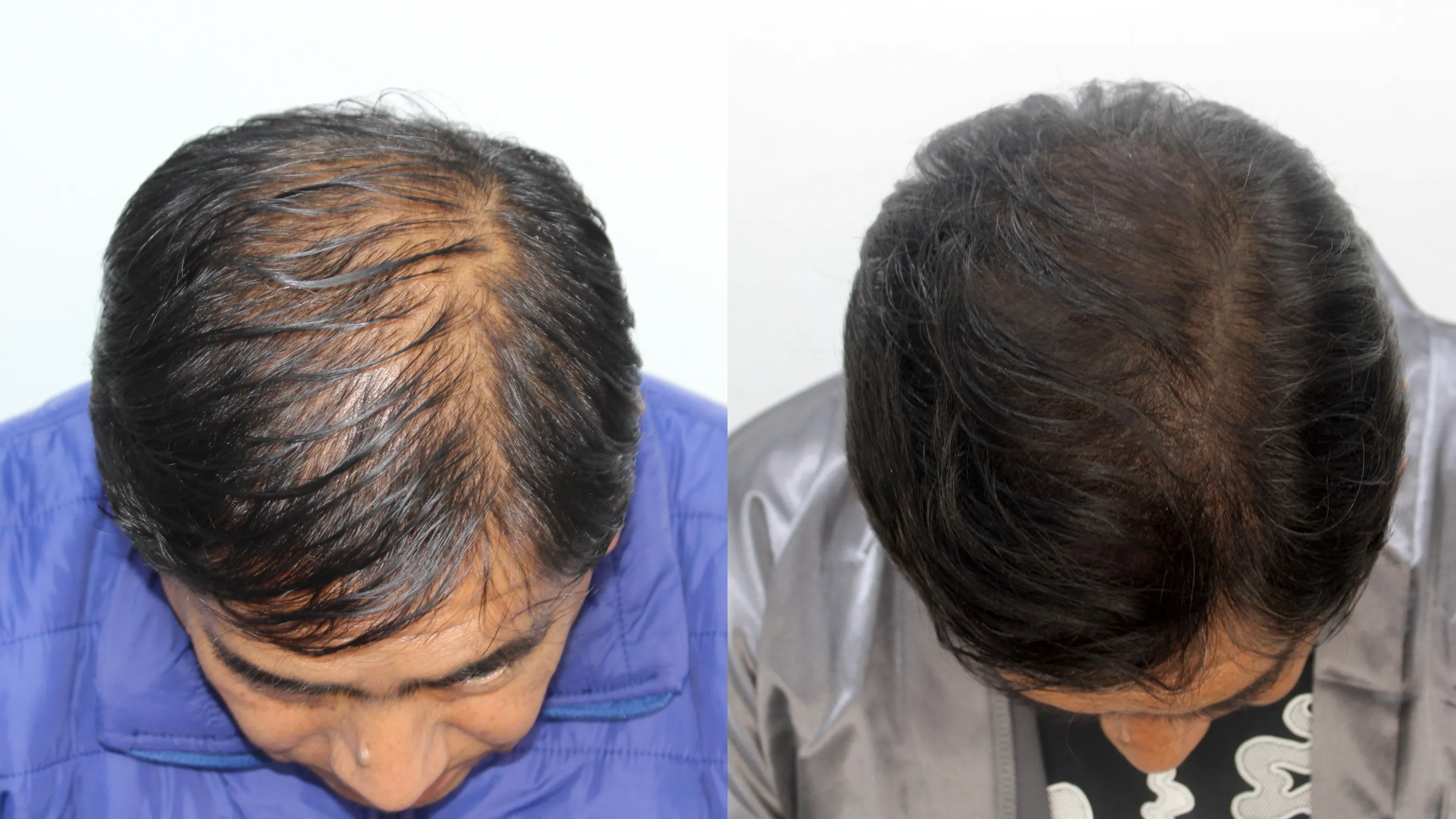 Resultado tratamiento capilar 5