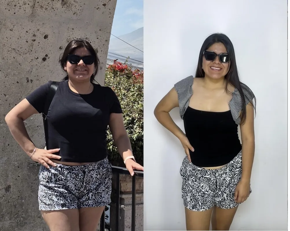 Resultado real de Irene con Criosculpting