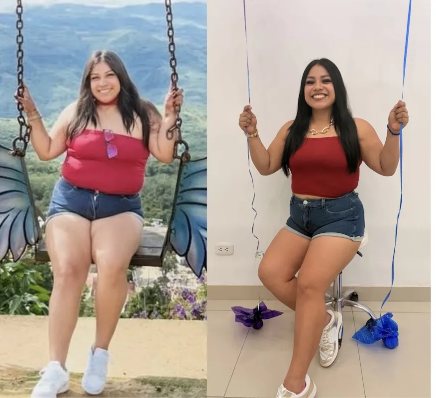Resultado real de Joyssi con Criosculpting