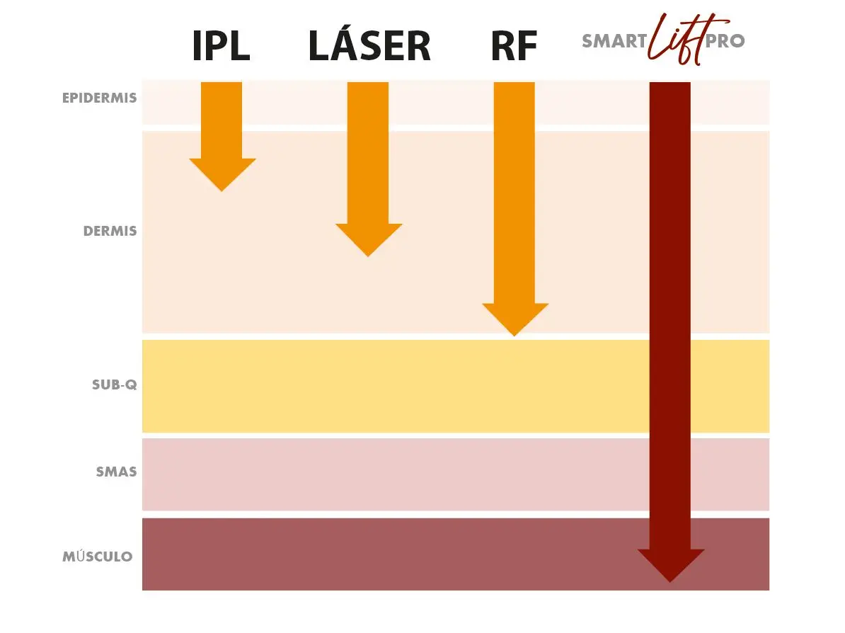 SmartLift® PRO vs otras tecnologías